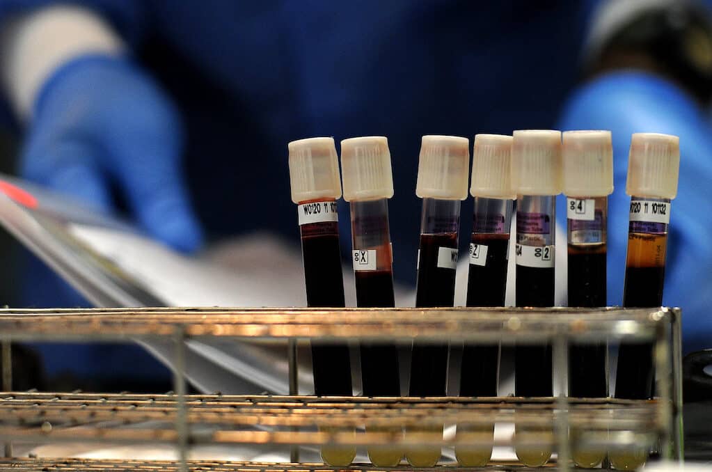 photo of vials of blood in rack